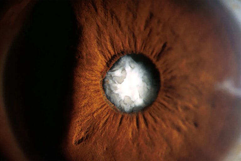 1800ss phototake rm photo of cataract on eye lens